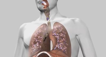 Les EFR au service du diagnostic de la fibrose pulmonaire idiopathique